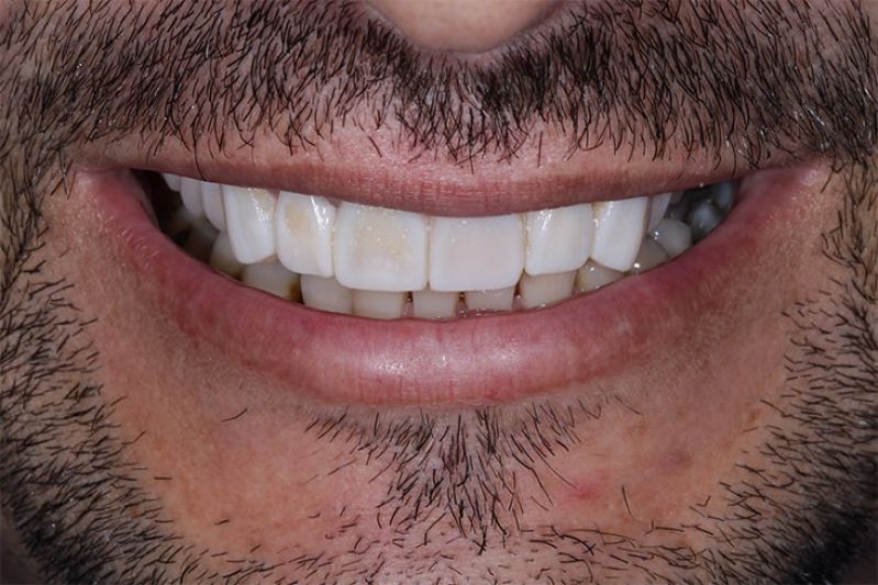 Facetas de cerâmica: o que você precisa saber